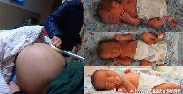 38岁孕妇二胎再怀3胞胎，划开肚子后，医生夸赞“真是座好宅”