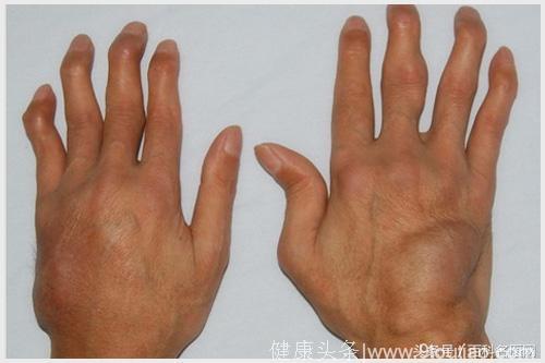 如果你的手指有这些症状，可能是被这个“不死癌症”盯上了！