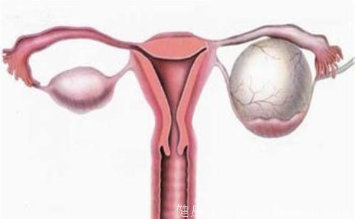 卵巢癌的早期症状有哪些？卵巢癌及时发现才能及早治疗