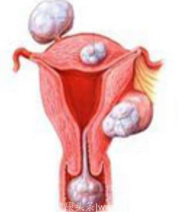 子宫肌瘤液化是什么意思？子宫肌瘤日常应该怎样护理才好？