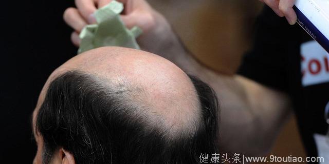 脱发研究新突破！日本毛囊再生疗法十年内或可普及