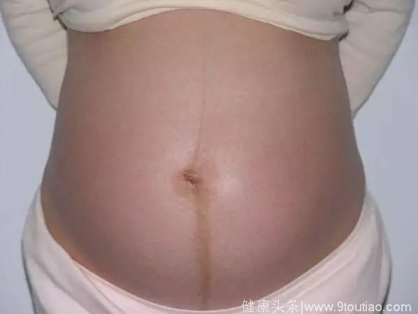 怀孕后肚皮上长很多毛是怎么回事？怀的是男孩吗？