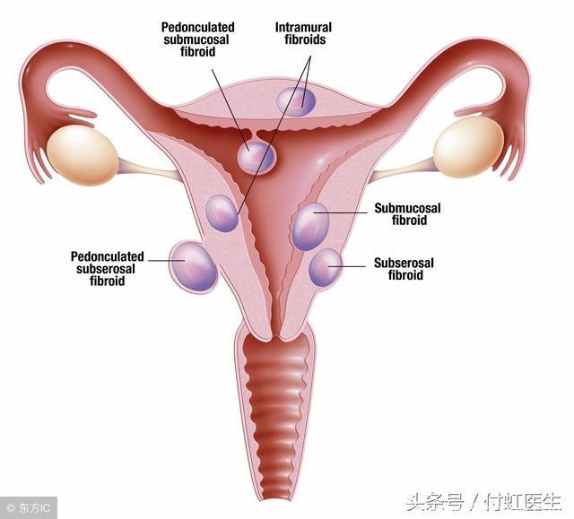 42岁，早孕9+周，超声发现子宫肌瘤，如何顺利度过孕期？