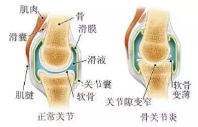 受用二十年——骨关节最怕的5个字