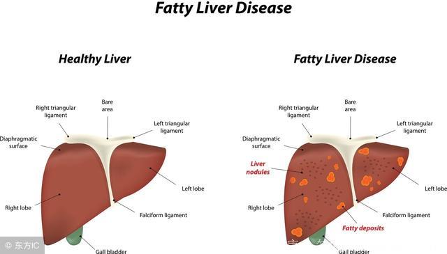 得了脂肪肝，无论轻重一定要重视！