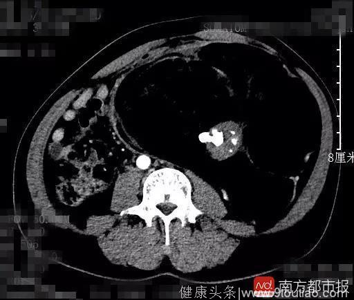 深圳一男子9斤重肚腩减肥减不掉 一查病因吓一跳