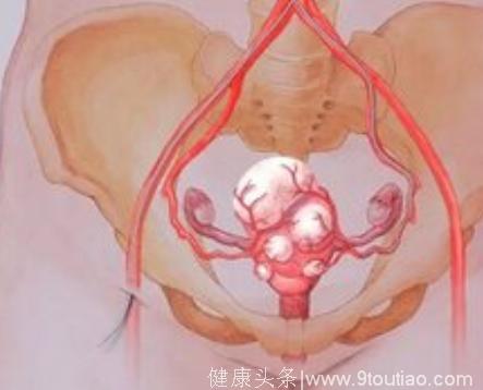 女性尿频、便秘是怎么回事？很可能是子宫长肌瘤引起的！