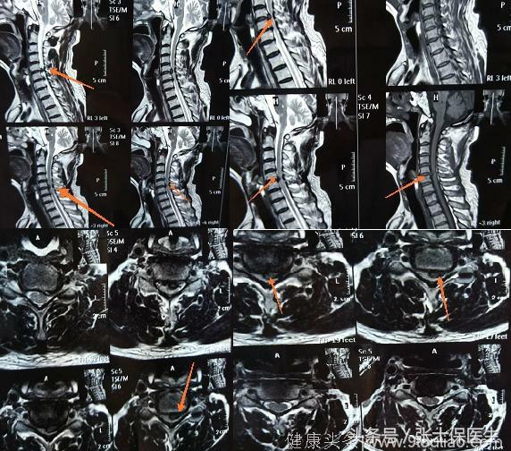 脊髓型颈椎病症状图片