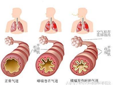 最新：典型支气管哮喘的5个诊断标准！