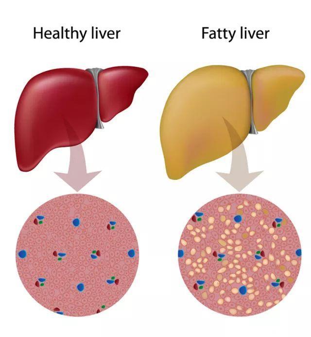 《细胞》子刊：两周甩掉脂肪肝，养好产生叶酸的肠道微生物是关键｜临床大发现