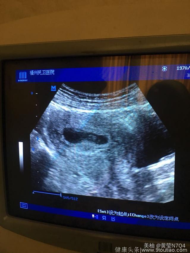 男孩胎囊图片 两个月图片