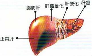 肝病专家：肝病为啥这么恐怖？！做这几件事，肝病远离你！