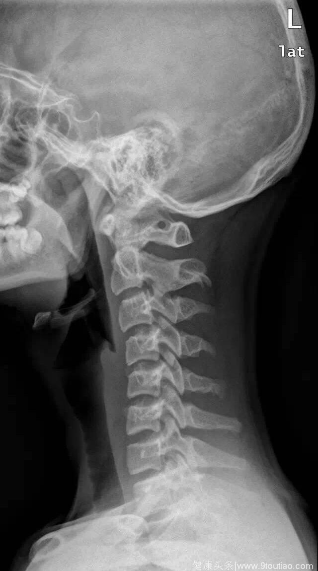 颈椎生理弯曲变直就意味着患了颈椎病了吗？