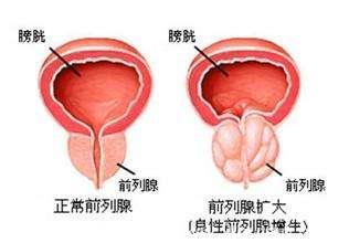 治疗前列腺增生症常用的中成药有哪些？如何选择使用？