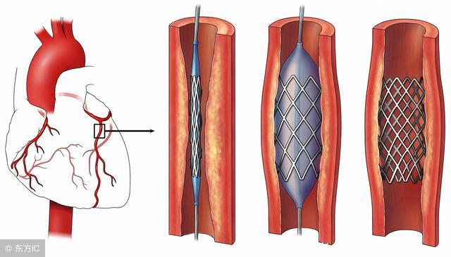 冠心病丨国产支架和进口支架区别大吗？手术后要注意哪些事情？
