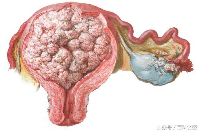 5种症状需警惕子宫内膜癌！子宫内膜癌的发生与哪些因素有关？