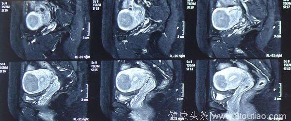 中国黑科技 专克癌症的海扶刀