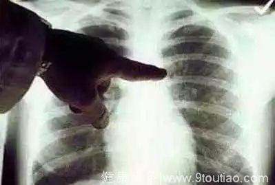 怪象！中国的女性肺癌患者，80%从不吸烟，她们为什么得癌？