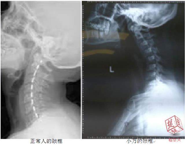 20岁女孩颈椎反弓30度，坐过山车下来脖子动不了