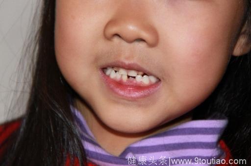 5岁换牙是早熟吗？儿童一般从几岁换牙？
