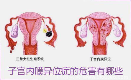 京军妇科专家详解：妇科常见病—— 子宫内膜异位症