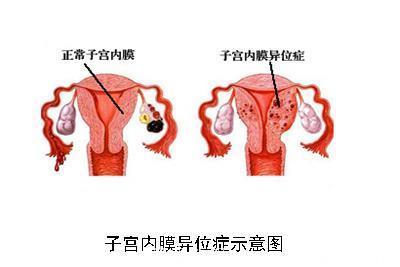 京军妇科专家详解：妇科常见病—— 子宫内膜异位症