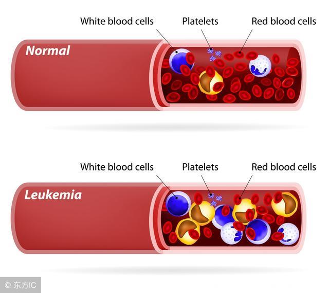 急性粒细胞白血病应与哪些疾病作鉴别