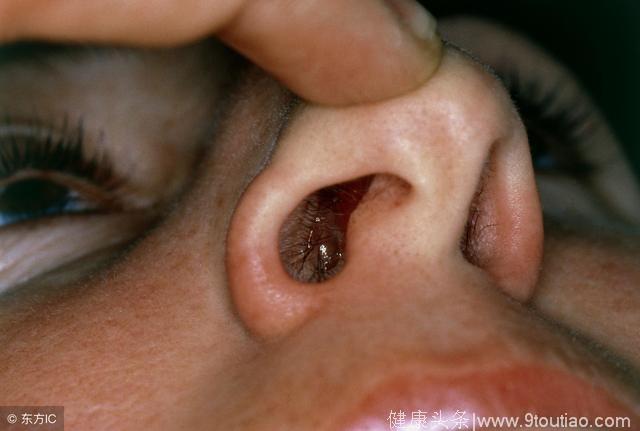 鼻炎患者的鼻腔内部图图片