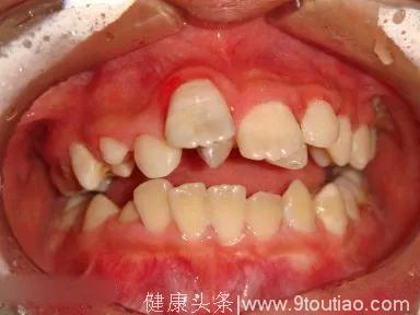 越早看医生越好!12岁前应该处理的20种儿童牙颌畸形
