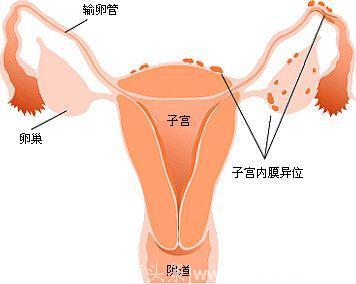 什么是子宫内膜异位症！