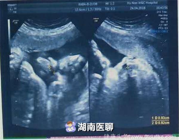 湖南女子怀孕32周，胎儿却患唇腭裂，去还是留？