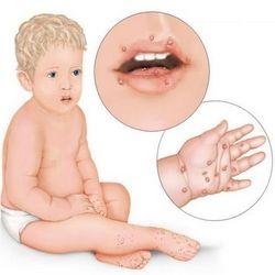 手足口高发期，如何区分手足口与疱疹性咽峡炎