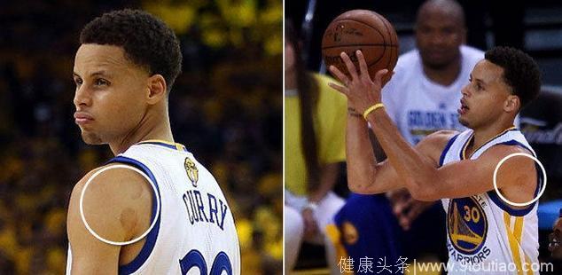 詹姆斯用拔火罐恢复身体 还有哪些NBA球员被火罐“征服”？