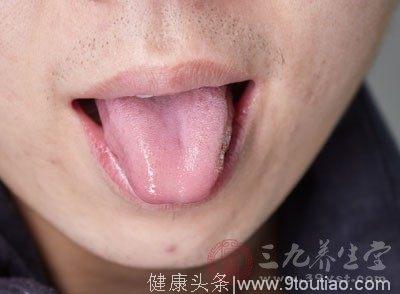 肝瘿线舌头图片