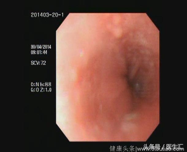 一例表现为哮喘的不典型胃食管反流病病例