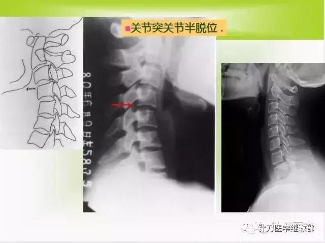 教你读懂颈椎影像