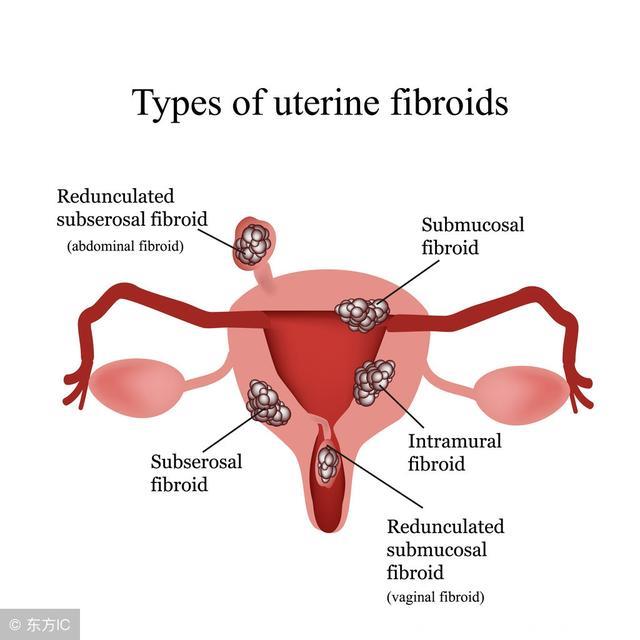 子宫肌瘤的变性情况与继发变性