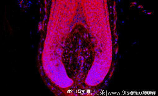 英国新发现：男性脱发用骨质疏松药物“一天就能见成果”