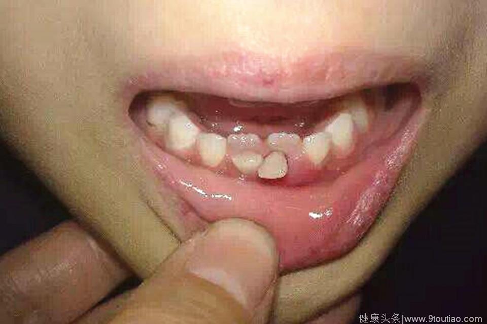 7岁孩子一张嘴出现两排牙,医生诊断后,发现毛病出在妈妈身上