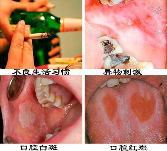 口腔癌痛吗图片