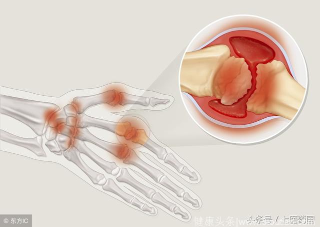 骨性、类风湿关节炎