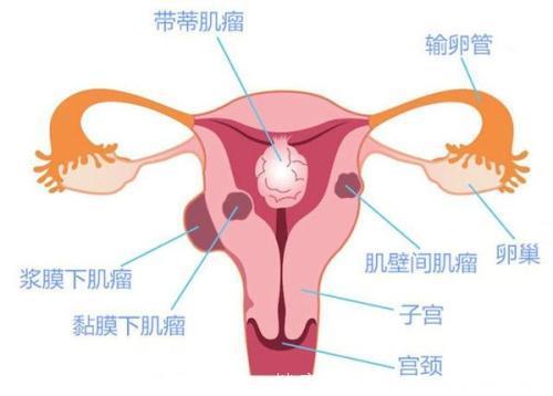 子宫肌瘤一定要切除？关于子宫肌瘤的5大疑惑，需要了解一下