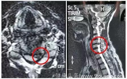 颈椎手术：让中年患者免于高位截瘫