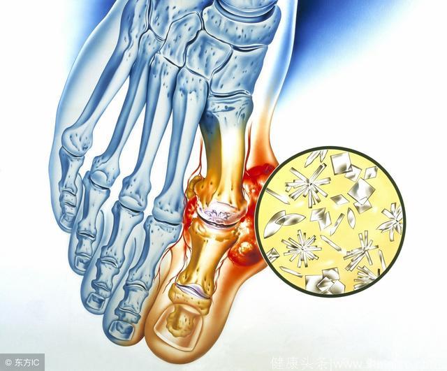 医生揭秘：对付痛风，常做4件事，轻松将尿酸排出去