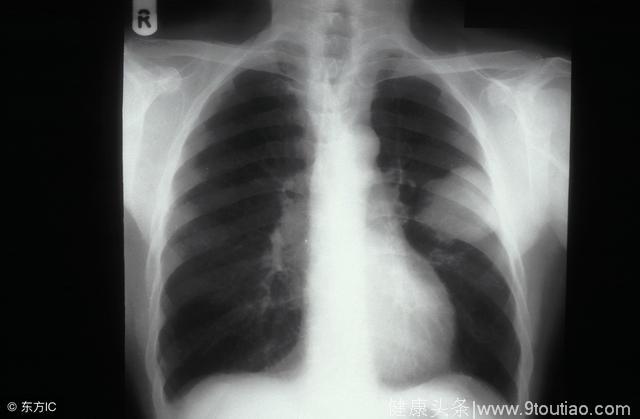 肺腺癌患者化疗后的存活期怎么判定