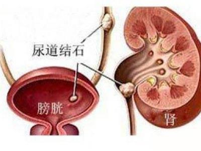 膀胱结石尿频、尿痛、尿血下午入院，按一穴喝一汤，次日上午出院