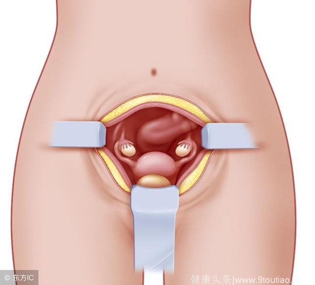 女性不要忽略宫颈息肉的危害性