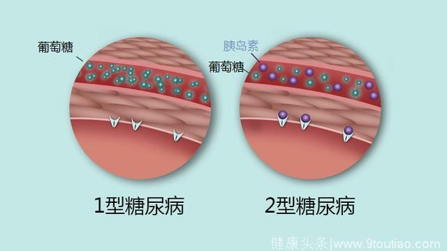 得糖尿病这么久没明白1型和2型的区别，看了这篇终于知道了