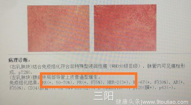 什么是乳腺癌的“三阴、三阳、二阳、一阳”？哪种预后最好？