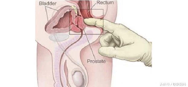 两分钟读懂前列腺液的常规检查